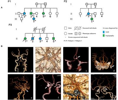 A Rare Variant of ANK3 Is Associated With Intracranial Aneurysm